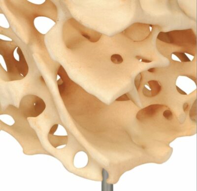 Cancellous Bone A99 1