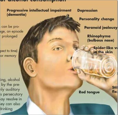 Alcohol Dependence Chart VR1792 2