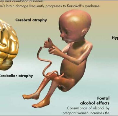 Alcohol Dependence Chart VR1792 1