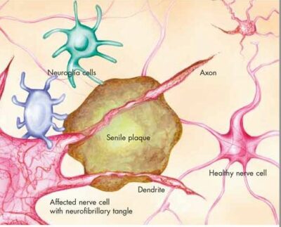 Alzheimer’s Disease Chart VR1628 2