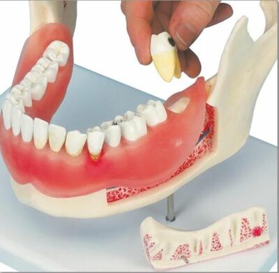 Dental Disease D26 2