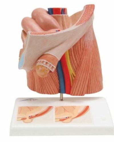 Inguinal Hernia Model H13 1