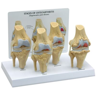 Knee 4 Stage Osteoarthritis G110 1