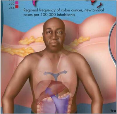 Colon Cancer Chart VR1432 2