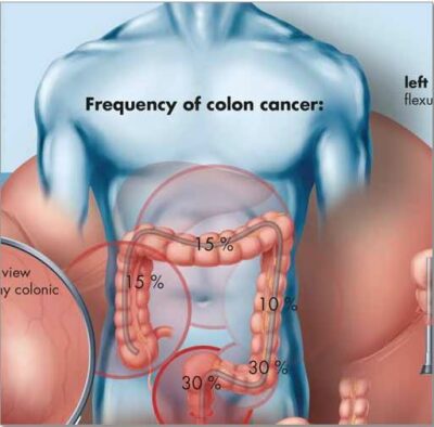 Colon Cancer Chart VR1432 1