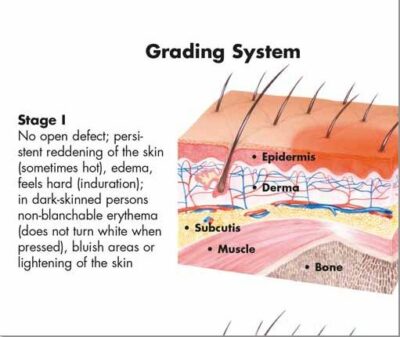 Decubitus Ulcers Chart VR1717 2