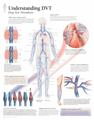 Deep Vein Thrombosis (DVT) 1652 1