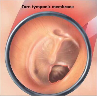 Diseases of the Middle Ear Chart VR1252 1