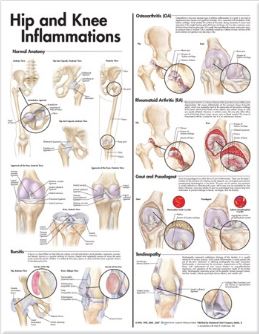 Hip and Knee Inflammations Anatomical Chart 9781
