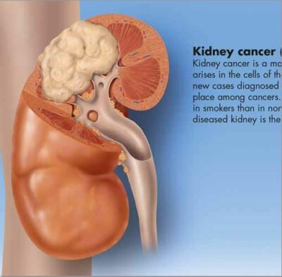 Kidney Chart VR1515 2