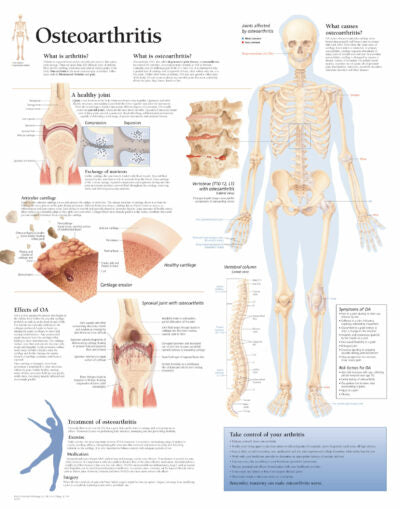 Osteoarthritis 1050 1