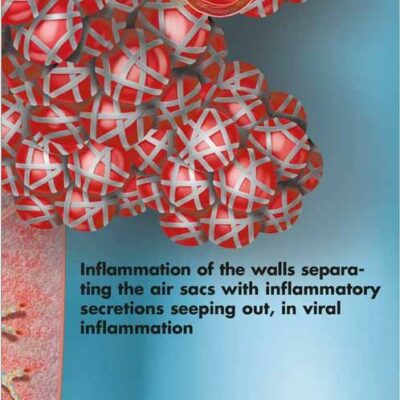 Pneumonia Chart VR1326 2