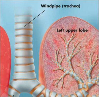 Pneumonia Chart VR1326 1