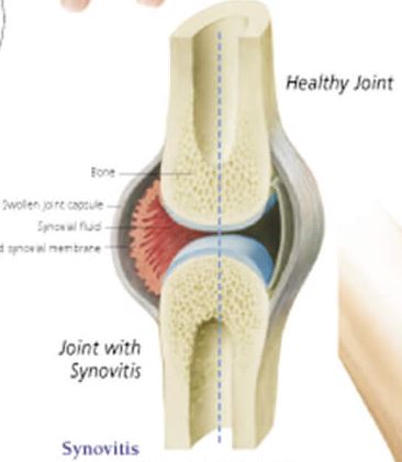 Rheumatoid Arthritis 1152 3