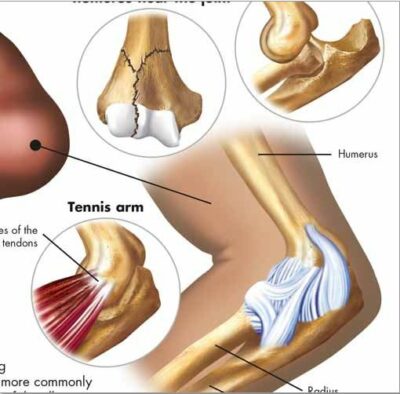 Sports Injuries Chart VR1188 1