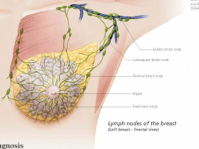 Understanding Breast Cancer 5501 3