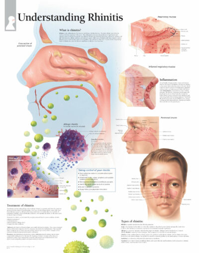 Understanding Rhinitis 1353 1