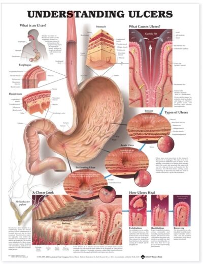Understanding Ulcers Anatomical Chart 9731 1