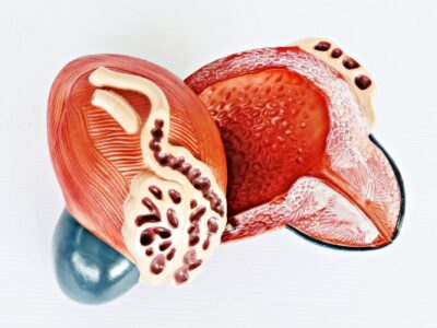 Expansion of Bladder Model IT055 5
