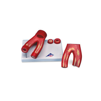 Arterosclerosis – Cross Section of Artery 2 Part  G40 2