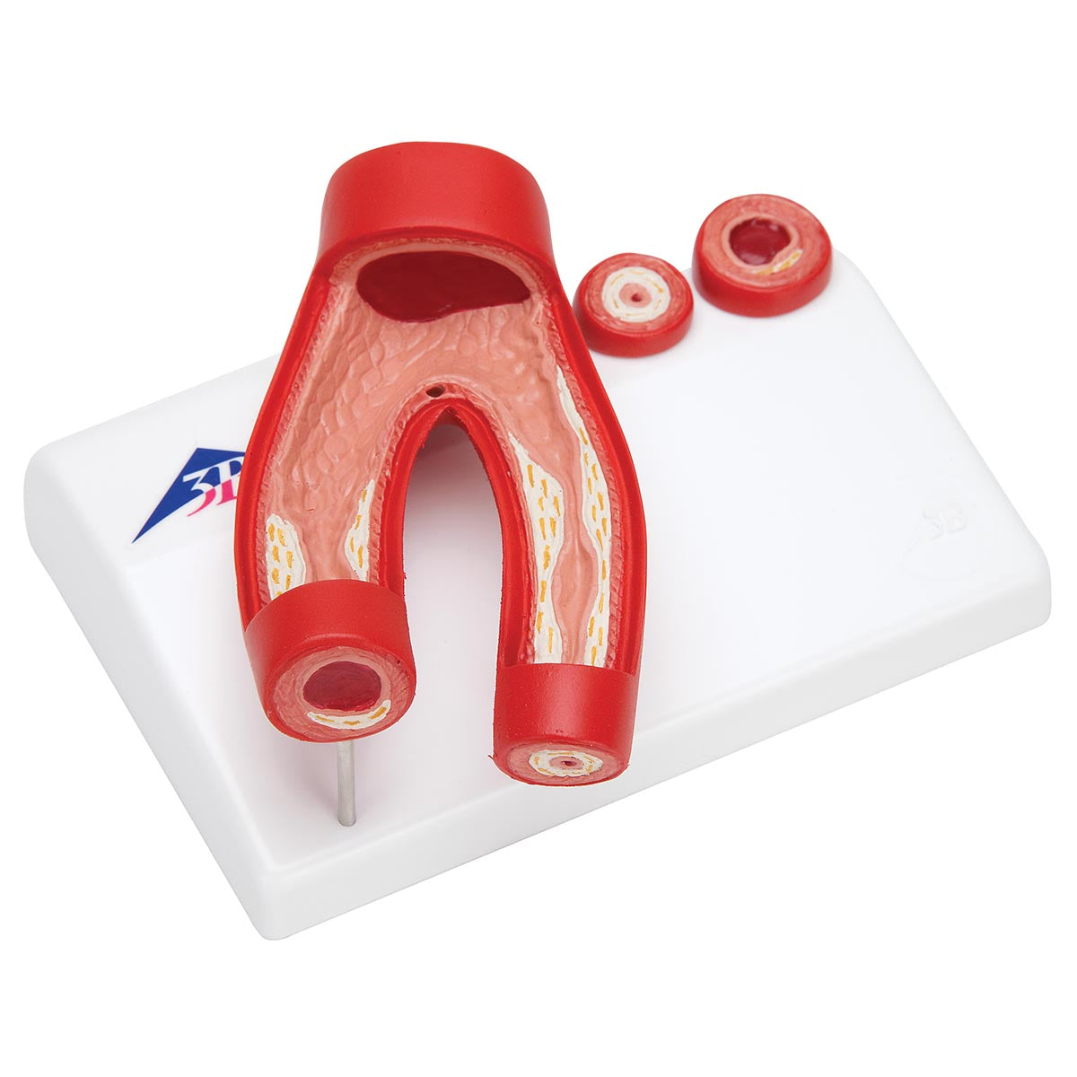 Arterosclerosis – Cross Section of Artery 2 Part  G40