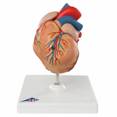 Classic Heart with Left Ventricular Hypertrophy (LVH), 2 part G04 1