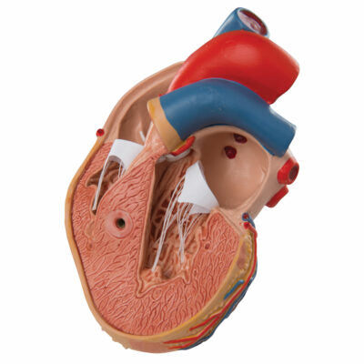 Classic Heart with Left Ventricular Hypertrophy (LVH), 2 part G04 3