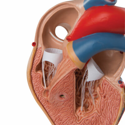 Classic Heart with Left Ventricular Hypertrophy (LVH), 2 part G04 2