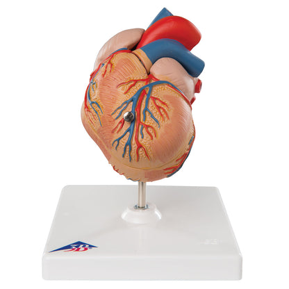 Classic Heart with Left Ventricular Hypertrophy (LVH), 2 part G04
