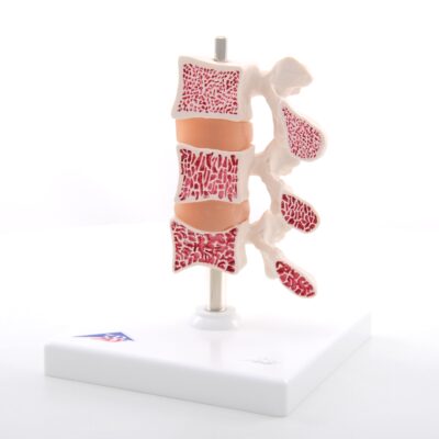 Deluxe Osteoporosis Model A78 1
