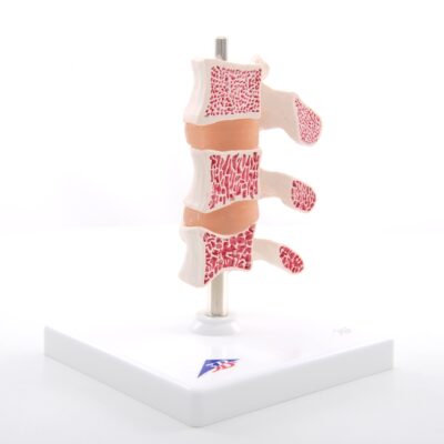 Deluxe Osteoporosis Model A78 2