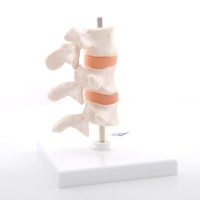 Deluxe Osteoporosis Model A78 3