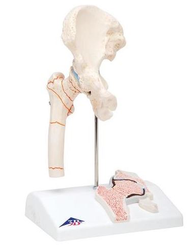 Femoral Fracture and Hip Osteoarthritis A88