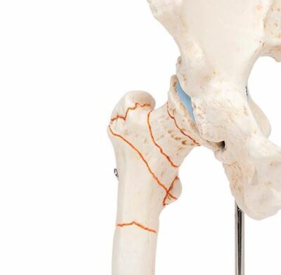 Femoral Fracture and Hip Osteoarthritis A88 1