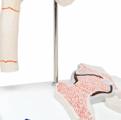 Femoral Fracture and Hip Osteoarthritis A88 2