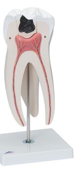 Giant Molar with Dental Caries D15 2