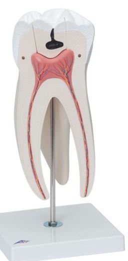 Giant Molar with Dental Caries D15 3