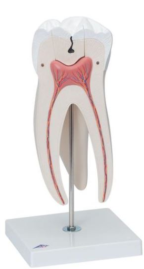 Giant Molar with Dental Caries D15 4