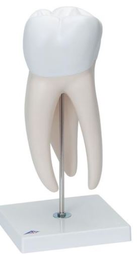 Giant Molar with Dental Caries D15