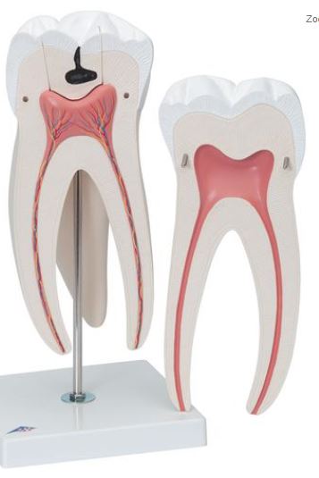 Giant Molar with Dental Caries D15 6
