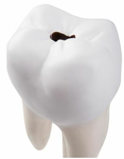 Lower Twin-Root Molar Showing  D10/4 2