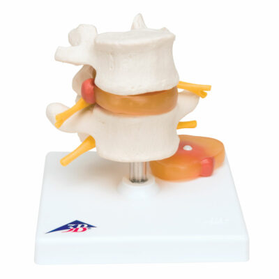 Lumbar Spinal Column with Prolapsed  Interverte D  A76 1