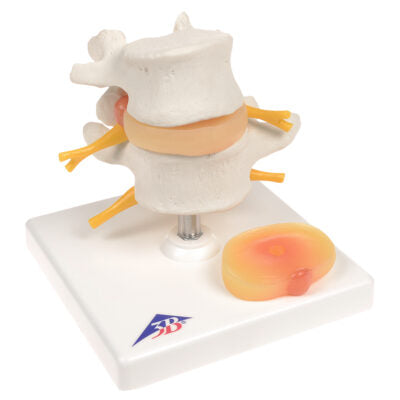 Lumbar Spinal Column with Prolapsed  Interverte D  A76 2