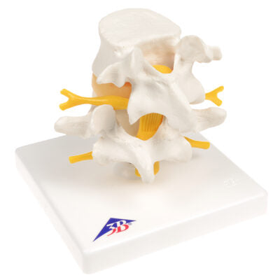 Lumbar Spinal Column with Prolapsed  Interverte D  A76 3
