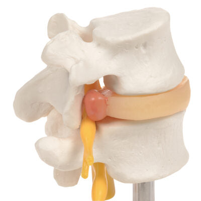 Lumbar Spinal Column with Prolapsed  Interverte D  A76 5