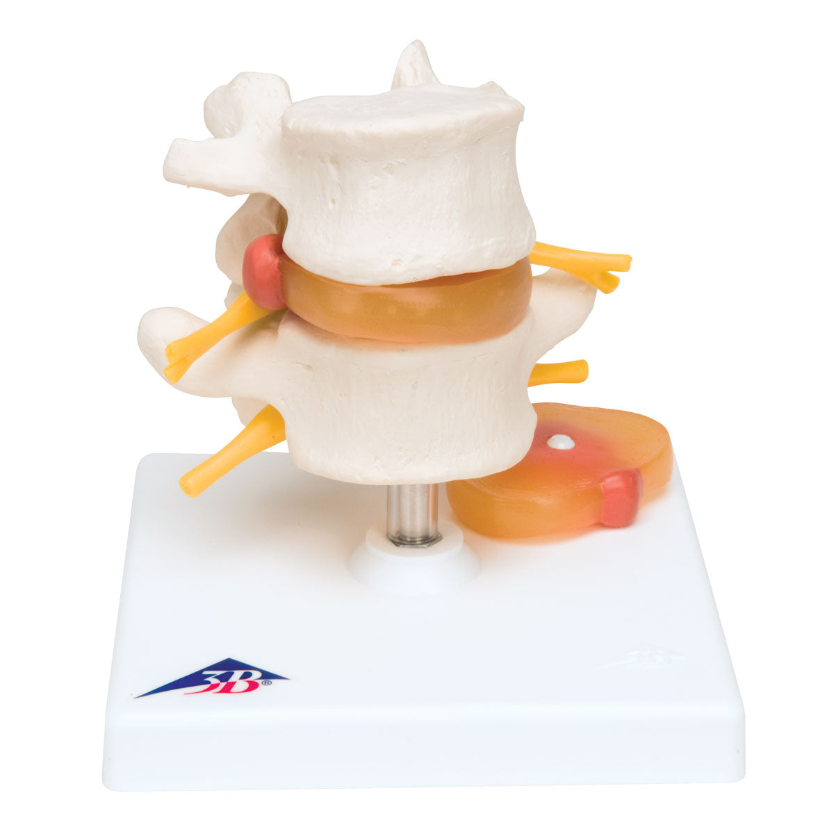 Lumbar Spinal Column with Prolapsed  Interverte D  A76