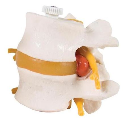 Lumbar Vertebrae 2 Part with Prolapsed Disc  A76/9