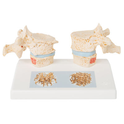 Osteoporosis Model A95 1