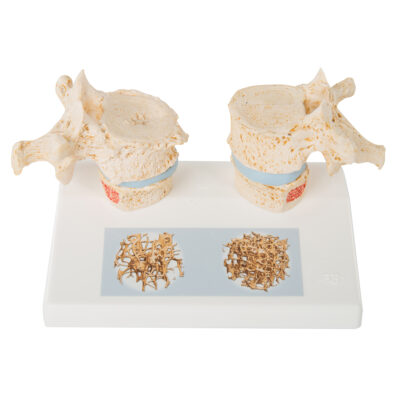 Osteoporosis Model A95 2