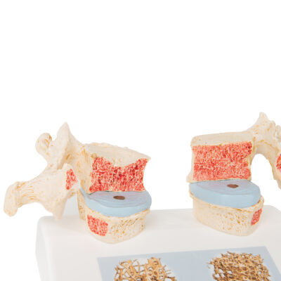 Osteoporosis Model A95 3